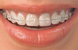 Ceramic Buccal Braces