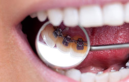 Hidden / Lingual Braces