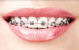 Metal Buccal Braces